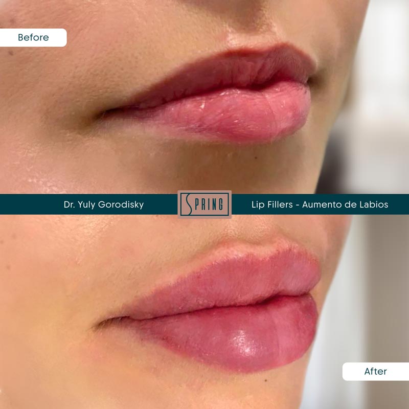 Lip Filler