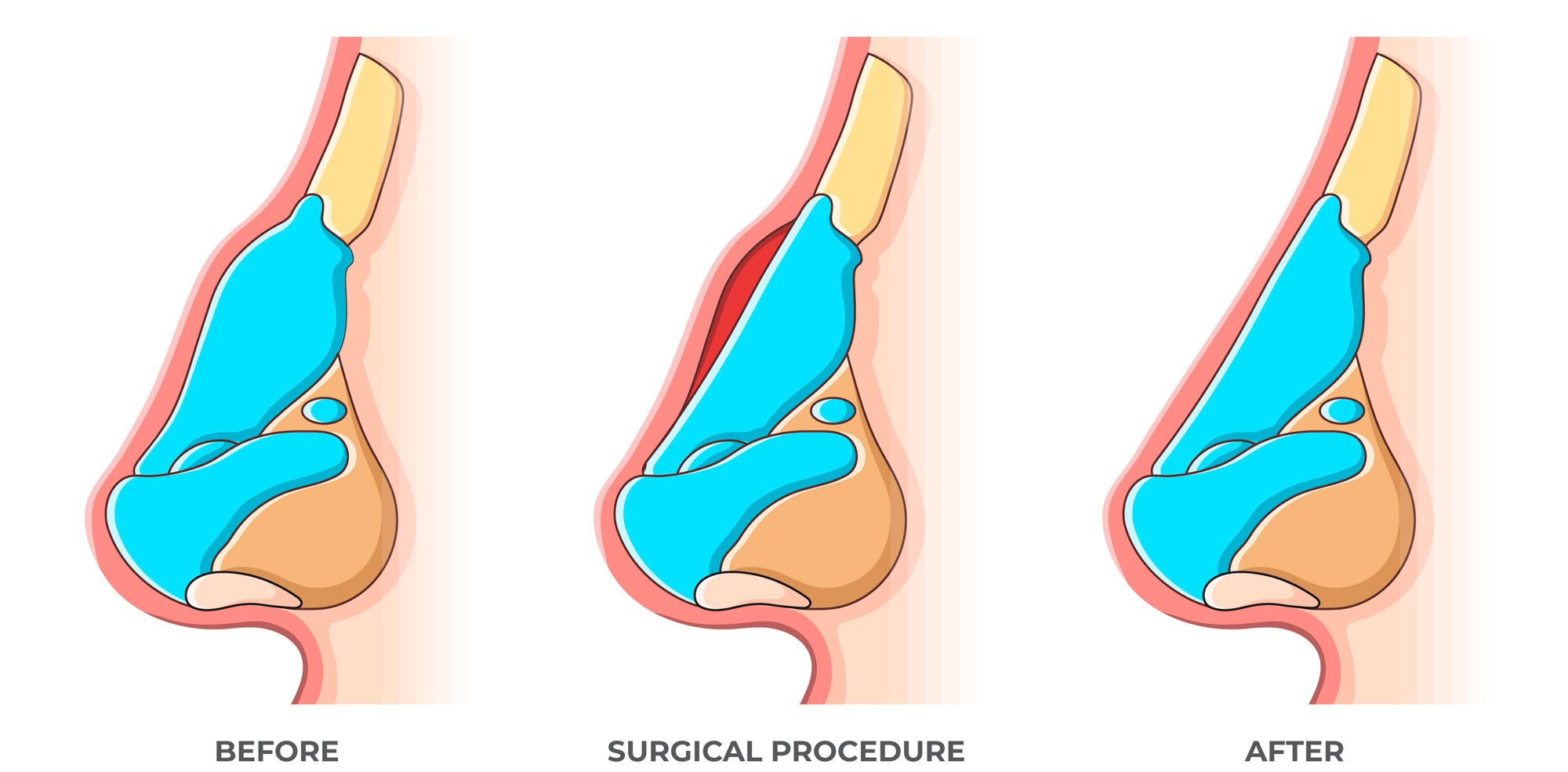 Rhinoplasty Cost in Miami