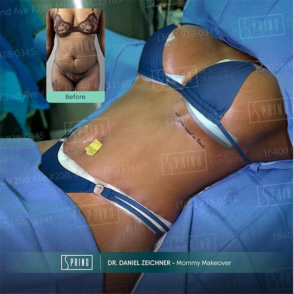 Mommy Makeover - Dr. Daniel Zeichner