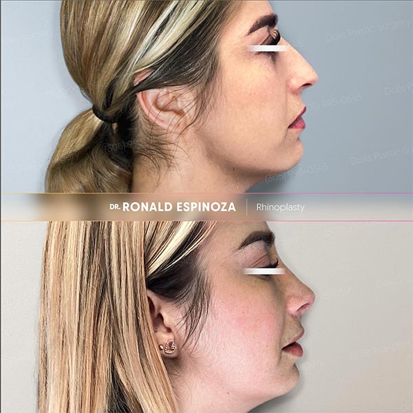 Rhinoplasty - Dr. Ronald Espinoza