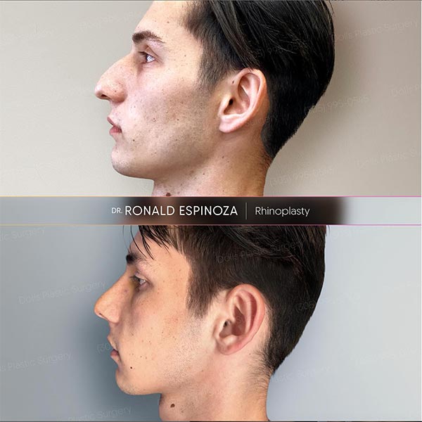 Rhinoplasty - Dr. Ronald Espinoza